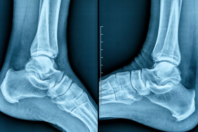 צילום רנטגן של כף הרגל. אילוסטרציה: שאטרסטוק