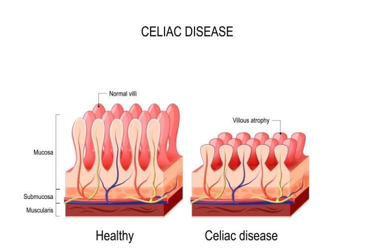 מנגנון מחלת הצליאק