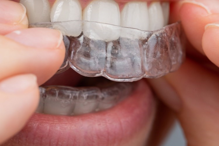 יישור שיניים למבוגרים