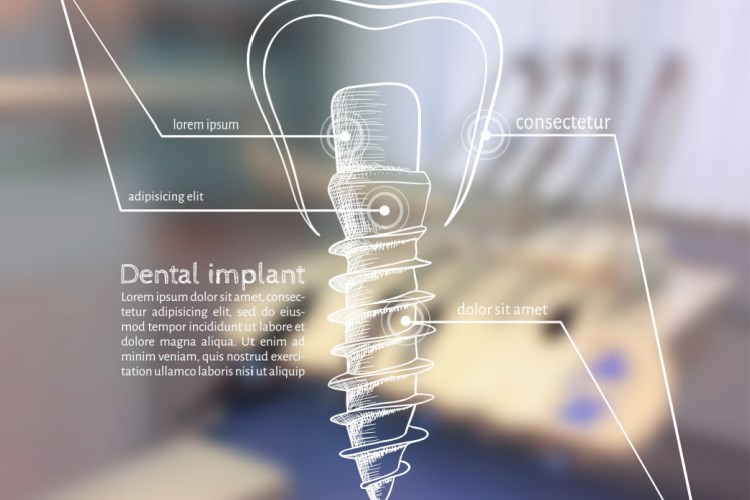 שתלים דנטליים