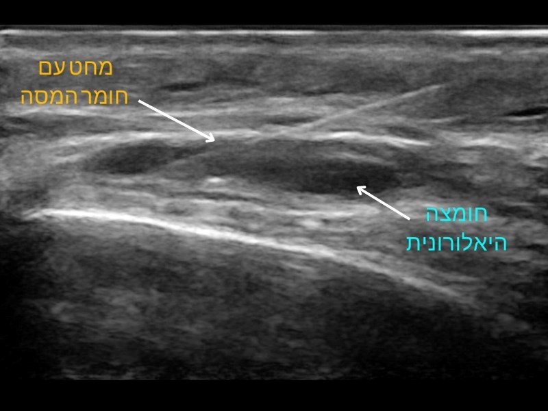 המסת חומצה היאלרונית