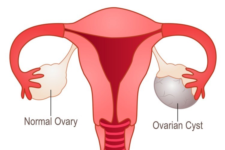 מימין, ציסטה בשחלה. משמאל, שחלה נורמלית. איור: שאטרסטוק