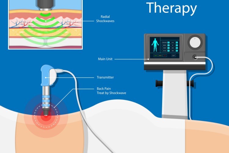 טיפול בגלי הלם