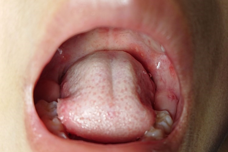 פצעים בפה מקשים על האכילה. צילום: שאטרסטוק