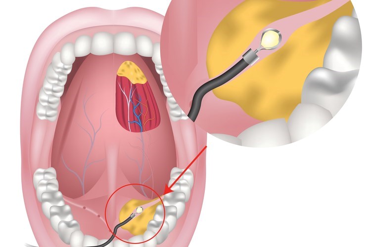 הסרת אבנים מבלוטות הרוק