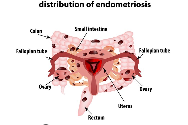 אנדומטריוזיס