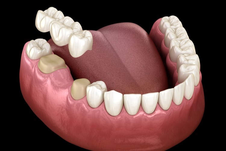 כתרים לשיניים