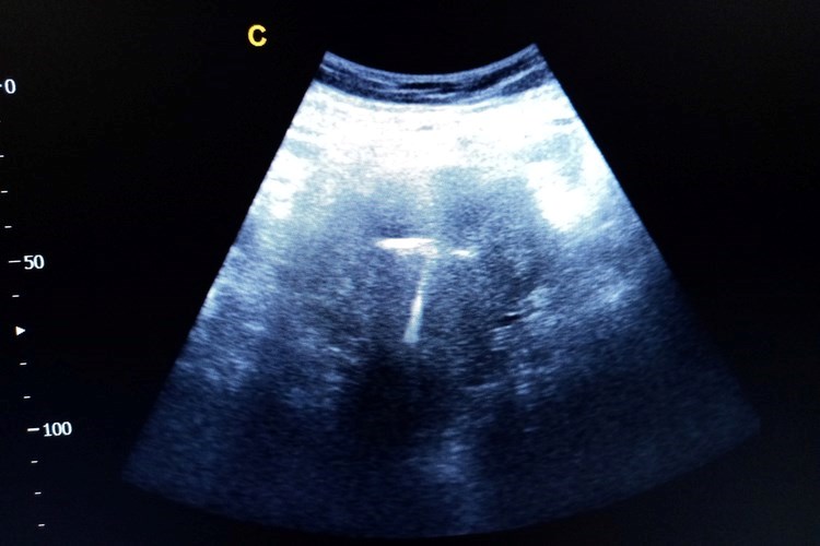התקן למניעת הריון באולטרסאונד