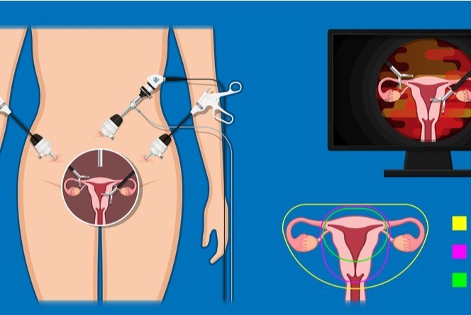 היסטרוסקופיה