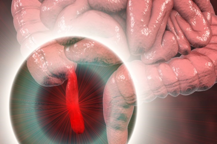 דלקת בתוספתן