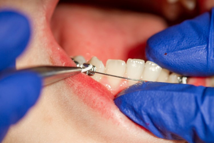 יישור שיניים