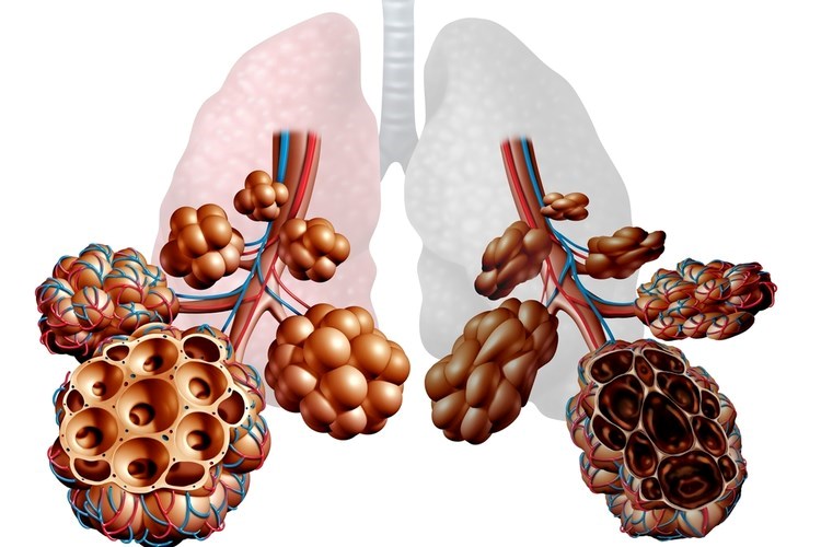 COPD