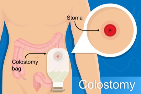 ניתוח כריתת רקטום מחייב יצירת יצירת קולוסטומיה. צילום: שאטרסטוק