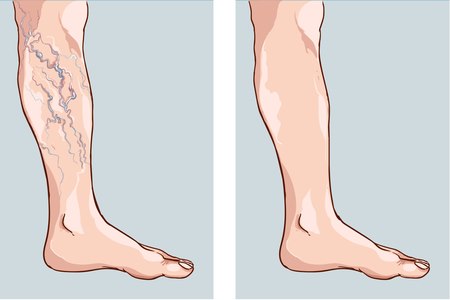 לפני ואחרי טיפול העלמת ורידים. צילום אילוסטרציה: שאטרסטוק