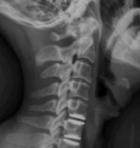 היצרות עמוד שדרה. צילום: ד"ר ליאור מרום 