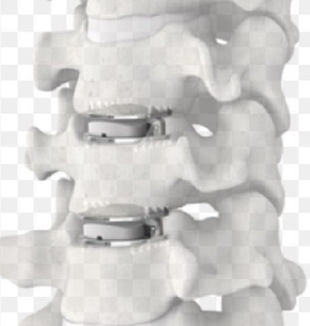 מודל של היצרות עמוד שדרה. אילוסטרציה: ד"ר ליאור מרום