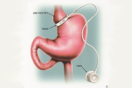 הצרת קיבה עם טבעת. אילוסטרציה: אסיא מדיקל