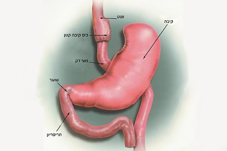 מעקף קיבה. אילוסטרציה: אסיא מדיקל