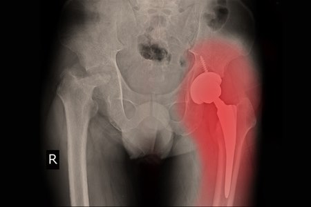 המטופלים שעברו ניתוח בגישה הקדמית הם שבעי הרצון ביותר. צילום: שאטרסטוק