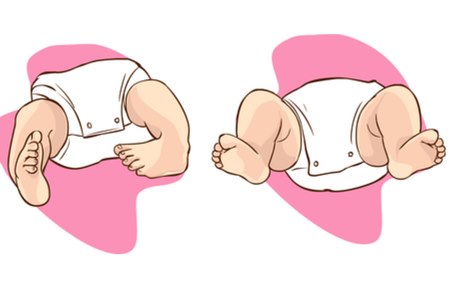 מימין - כפות רגליים תקינות, משמאל - קלאב פוט. צילום אילוסטרציה: שאטרסטוק