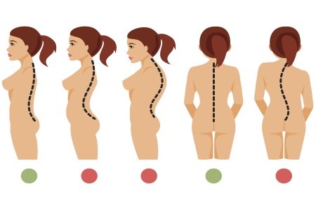 סוגי העקמת בעמוד השדרה. אילוסטרציה: thinkstock