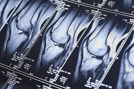MRI של הברך. אילוסטרציה: שאטרסטוק