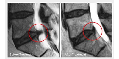 לפני ואחרי טיפול בפריצת דיסק (צילום: ד"ר יואב שטיין)