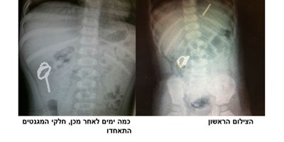החרוזים במעי של הפעוט. צילום: דוברות בי"ח רמב"ם
