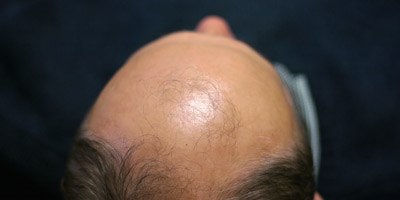 התקרחות גברית, טיפול (אילסוטרציה)