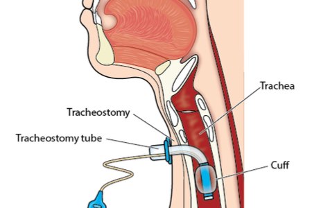 פיום קנה הוא הליך ניתוחי ליצירת מעקף לקנה הנשימה. צילום: שאטרסטוק