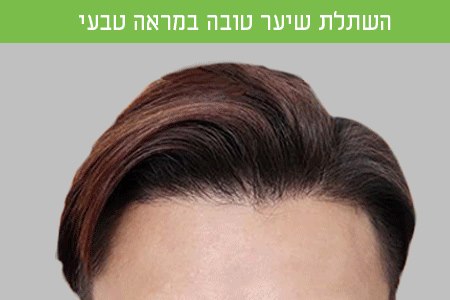 השתלת שיער מוצלחת היא בעלת המראה הטבעי ביותר