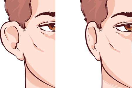 לפני ואחרי ניתוח להצמדת אוזניים. ניתן לבצע את הניתוח בכל גיל. צילום: שאטרסטוק