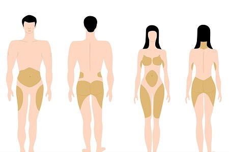 פיזור שומן בגוף. אילוסטרציה: שאטרסטוק