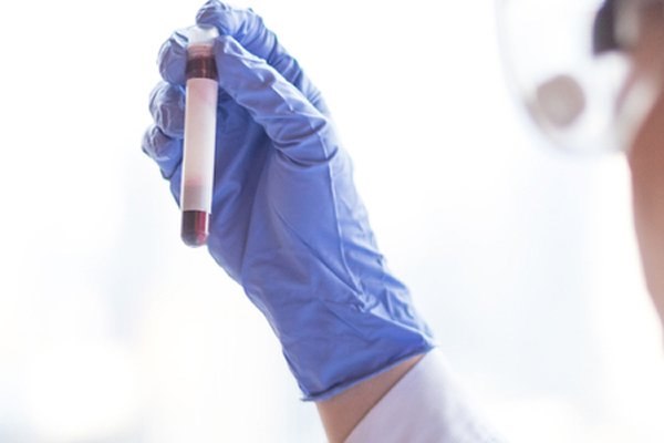 אבחנה של צליאק כוללת בעיקר בדיקת דם סרולוגית למחלה. צילום: שאטרסטוק