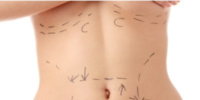 מתיחת בטן (אילוסטרציה צילום shutterstock)