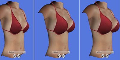 הדמייה של הגדלת שדיים (צילום: מרפאת ד"ר רוני מוסקונה)