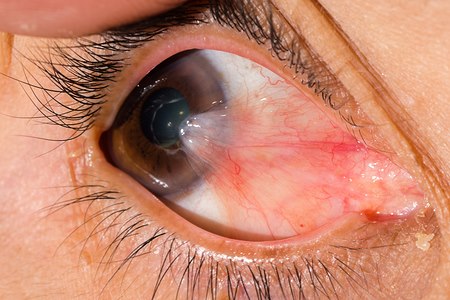 פטריגיום. אילוסטרציה: שאטרסטוק