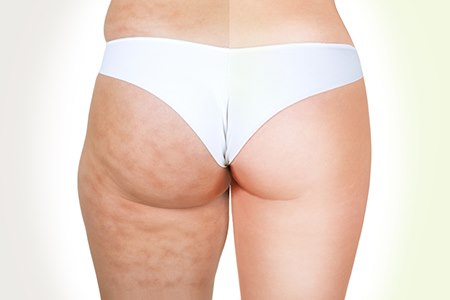 ירכיים "לפני ואחרי" שאיבת שומן (אילוסטרציה shutterstock)