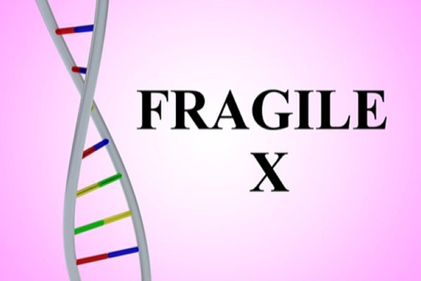 תסמונת X שביר, תסמונת גנטית הגורמת לפיגור שכלי. אילוסטרציה: שאטרסטוק
