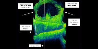 תמונה 3: משיכת המקולה ע"י ממברנות שאינן מרכזיות (צילום: פרופ