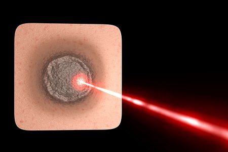 טיפול ממוקד ויעיל בנגע עור בעזרת קרן לייזר (אילוסטרציה shutterstock)