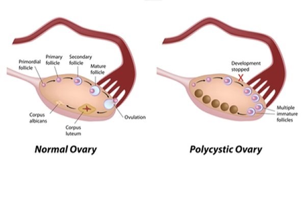 משמאל - שחלה רגילה, מימין - שחלה פוליציסטית. צילום: שאטרסטוק