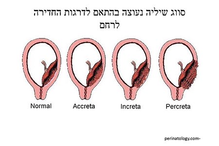 שיליה נעוצה מסווגת על פי דרגות חדירתה לרחם (איור: פרופ