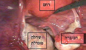 שחלות עם ציסטות