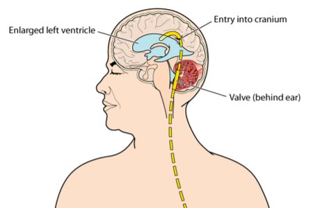  ניתוח להתקנת דלף  SHUNT. צילום: שאטרסטוק