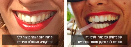 מימין: לפני טיפול פריודונטי, משמאל: לאחר טיפול. צילום: ד"ר ערן גבאי וד"ר יניב מאייר