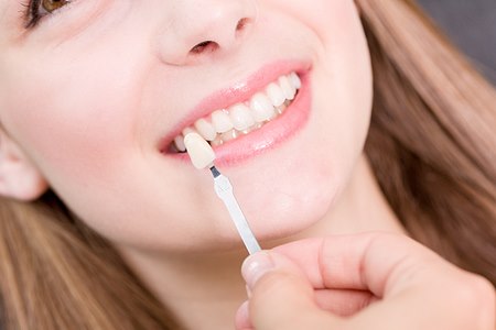 התאמת גוון מתאים לכתרים. אילוסטרציה: שאטרסטוק