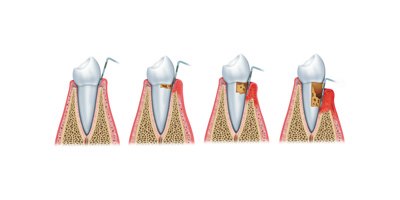 נסיגת חניכיים (צילום אילוסטרציה shutterstock)