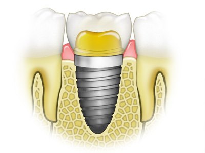 שתלים דנטאלים (אילוסטרציה. צילום shutterstock)