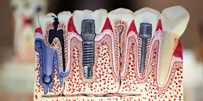 שתלים דנטאליים (אילוסטרציה)